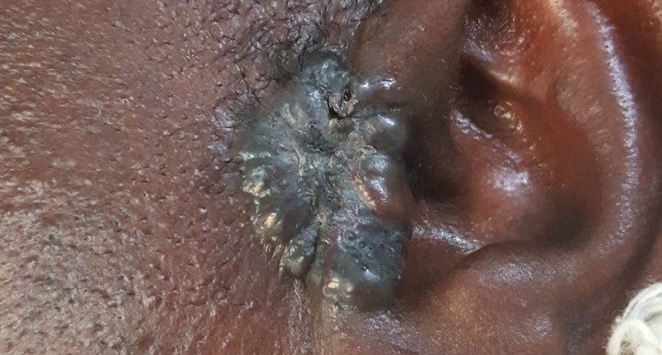 Cancer de la peau près de l'oreille