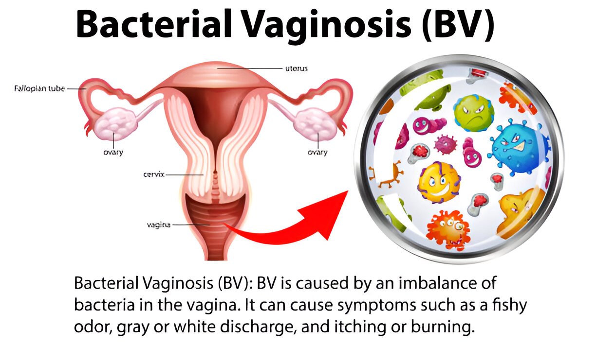 vous souffrez de vaginose bactérienne