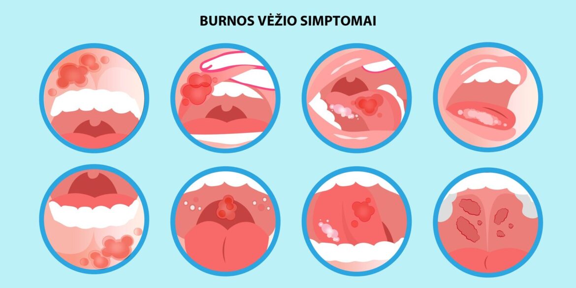 Faits et symptômes du cancer buccal