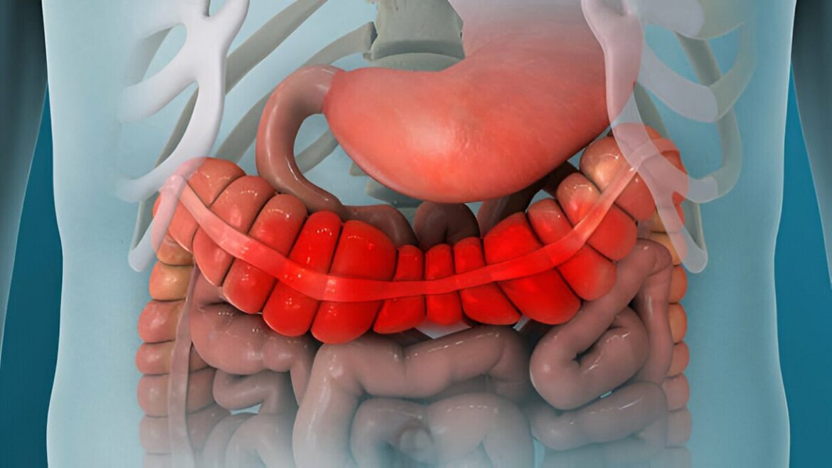 Qu’est-ce que le syndrome du côlon irritable avec constipation (SCI-C) ?