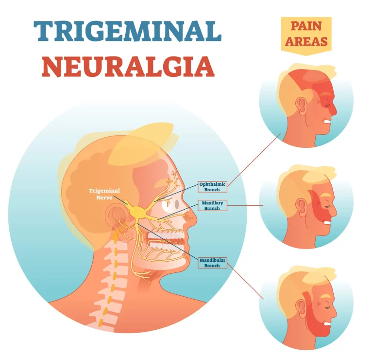 Illustration de la névralgie du trijumeau